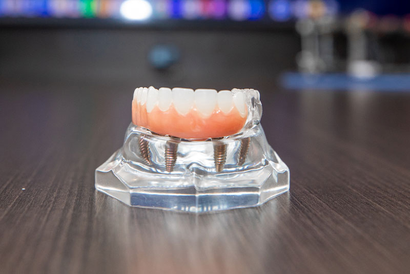 full arch dental implants